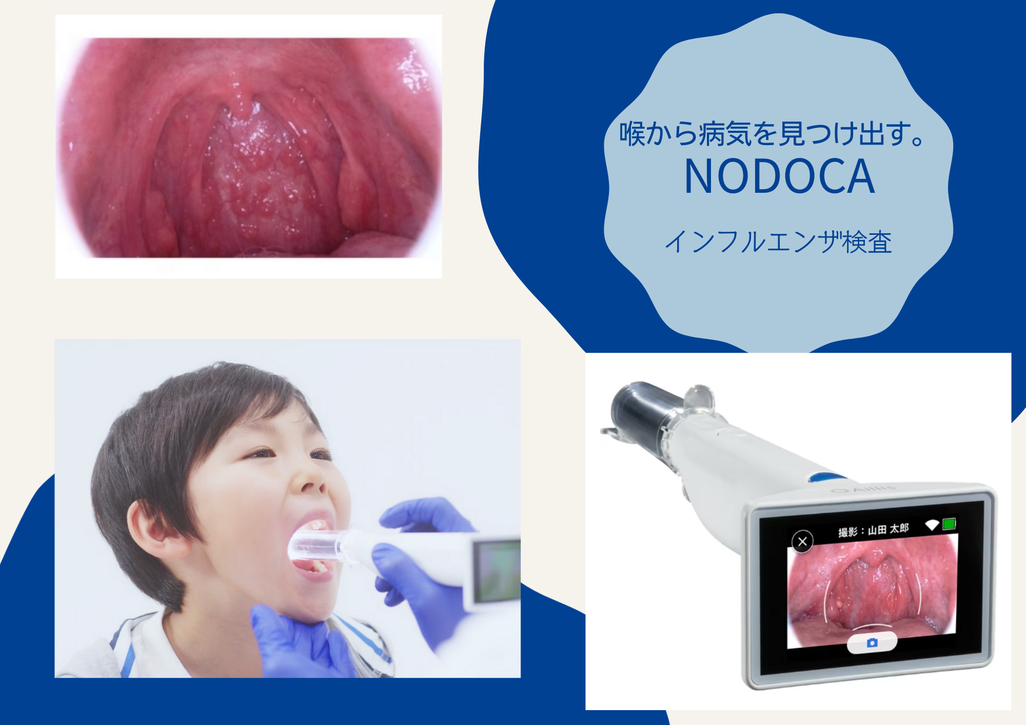 AIインフルエンザ検査 nodoca